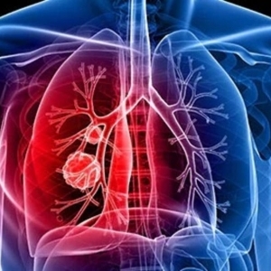 معلومات عن سرطان الرئة وطرق الوقاية والعلاج منه.. احذر التدخين