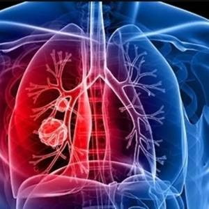 علامات تدل على الإصابة بسرطان الرئة.. أبرزها الكحة وضيق التنفس والخمول