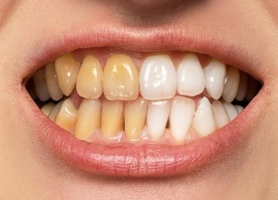 وصفة سحرية لتبييض الأسنان باستخدام مكونات طبيعية.. «موجودة في كل بيت»
