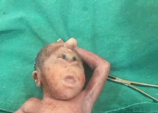 بعد ولادة طفل أرمنت.. 10 معلومات عن سبب الولادة بعين واحدة