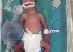 نجاح ولادة قيصرية لـ"توأم غير مكتمل" داخل مستشفى أبورديس