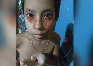 صور.. طفلة هندية تبكي "بدل الدموع دم" بسبب حالة مرضية نادرة