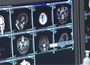 اكتشاف أكثر من 700 دودة شريطية في مخ ورئتي رجل صيني