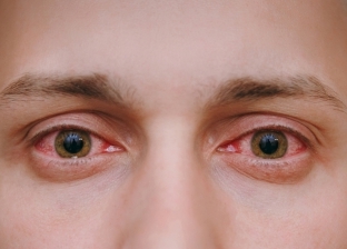 كيف تحمي عينيك من الالتهابات في الشتاء؟ استشاري بكتيريا تجيب