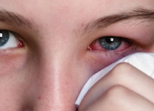 ملوش علاج.. كيف تتعامل مع مرض إنفلونزا العيون؟
