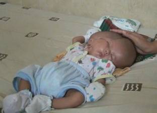 بالفيديو| ولادة طفل بوجهين في إندونيسيا
