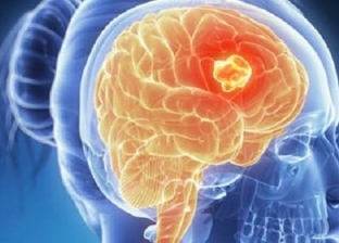 منها "النوم الكتير".. أعراض عادية قد تشير إلى الإصابة بسرطان الدماغ