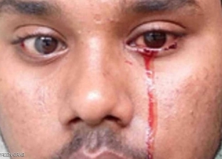 شاب هندي يحير الأطباء.. يبكي "بدل الدموع دم"