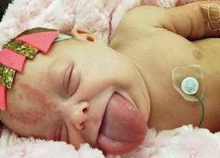 بالصور| طفلة أمريكية تبتسم لأول مرة بعد 16 شهرا من مولدها