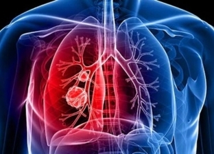معلومات عن سرطان الرئة وطرق الوقاية والعلاج منه.. احذر التدخين