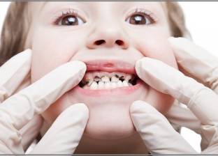 "العيادة" توضح أسباب تسوس الأسنان للأطفال في سن مبكر