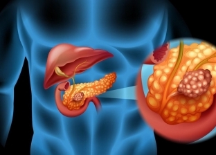 لا تستهون بآلام الظهر.. أول العلامات الخفية لسرطان البنكرياس
