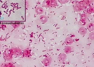 10 معلومات عن مرض «بكتيريا المسيسبي».. يتسبب في وفاة 90 ألف أمريكي