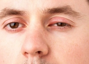 ما أسباب تورم العين عند الاستيقاظ من النوم؟.. 3 نصائح للتخلص منها