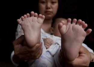 "داء الأصابع".. طفل صيني يولد بـ31 إصبعا دون إبهام واحد
