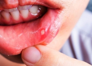 8 أمور تؤدي إلى إصابتك بـ قرح الفم.. إليك طريقة علاجها منزليا