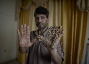 بالصور| "جروت" الفلسطيني.. يعاني من مرض نادر جعله "رجل الشجرة"