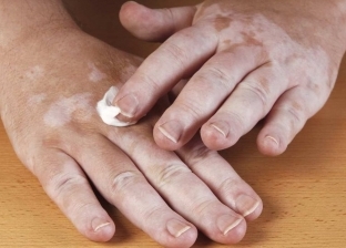 تعليمات استخدام علاج البهاق الجديد على الجلد.. ابعد عن الآثار الجانبية