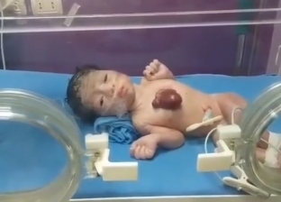 ولادة نادرة لطفل بقلب خارج الجسم.. حالة من كل 5.5 مليون «فيديو»