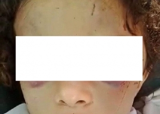 بعد استغاثة عبر "فيس بوك".. تضامن الشرقية تفحص واقعة تعذيب طفلة على يد خالتها