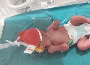 بالصور| ولادة طفل غير مكتمل نمو الرئة بمستشفى أبو رديس المركزي