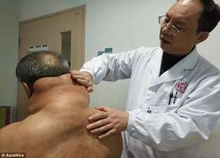 بالصور| نمو الدهون حول عنق مسن صيني بسبب تناول الكحول