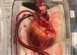 فيديو.. نجاح أول عملية لزراعة قلب ميت بالولايات المتحدة