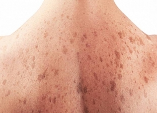 استشاري جلدية: أصحاب البشرة البيضاء أكثر عرضة للإصابة بسرطان الجلد