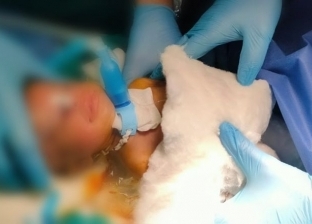 لأول مرة.. إجراء جراحة شق حنجري لطفل عمره 54 يوما بالسويس