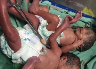 بعد ولادة طفل بـ"عين واحدة".. مستشفى أرمنت بالأقصر تستقبل عدة توائم