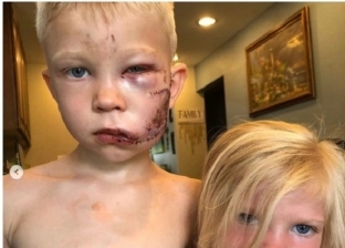 دفاعا عن حياة شقيقته الصغرى.. طفل يتلقى 90 غرزة في وجهه بسبب كلب