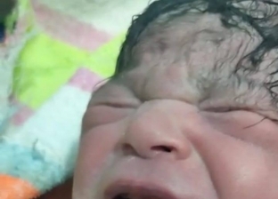 أغرب حالات الولادة في مصر: طفلة بأسنان وذكر براسين وآخر بعين واحدة