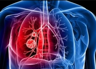 علامات تدل على الإصابة بسرطان الرئة.. أبرزها الكحة وضيق التنفس والخمول