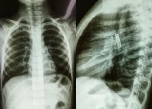كحة استمرت 3 أشهر تكشف عن جسم غريب داخل رئة طفل.. ظهر بالأشعة السينية