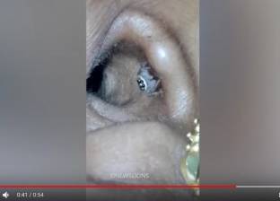 بالفيديو| "امرأة العنكبوت": عشش في "أذني" منذ أيام "ويشعرني بألم"