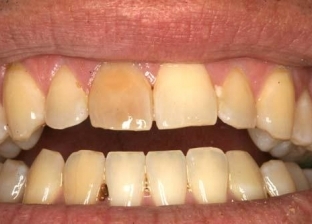 3 طرق للتخلص من اصفرار الأسنان.. «عشان تضحك براحتك»