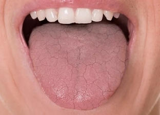 5 أمراض خطيرة يشير إليها جفاف الفم.. «ماتستهونش بها»