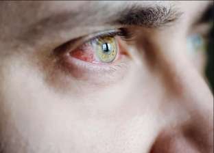 طبيب: التعرض لأشعة الشمس لفترات طويلة قد يسبب «قرحة» في العين