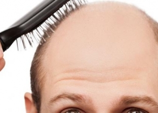 صالون يبحث عن "الصُلع" لتصوير إعلان تركيب شعر بـ3 آلاف جنيه وباروكة