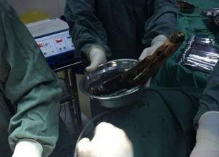 بالصور| صيني يستخدم "باذنجانة" طولها 12 بوصة لعلاج الإمساك