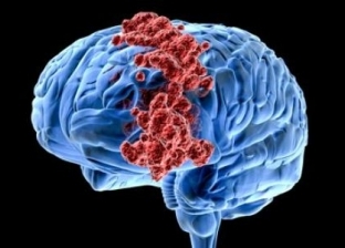 علماء بريطانيون يربطون "ضباب الدماغ" بالتهابات في الجسم