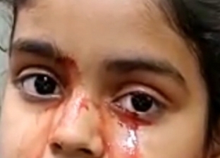 تبكي "بدل الدموع دم".. حالة نادرة لطفلة عمرها 11 عاما تحير الأطباء