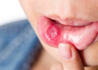 علاج قرح الفم في المنزل بـ4 خطوات بسيطة.. تخلص منها سريعا