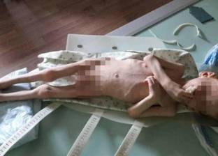 صورة مروعة لطفل تركه والداه يموت جوعا فصار "جلد على عضم"