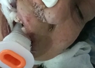 خروج «دود» من أنف مصاب بكورونا في عزل كفر الدوار.. وأطباء: حالة نادرة