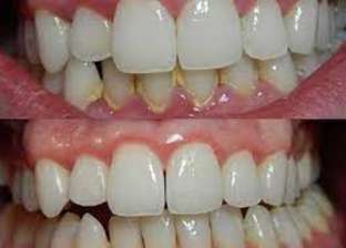 4 طرق منزلية تساعد على التخلص من الجير الأبيض للأسنان.. أبرزها خل التفاح