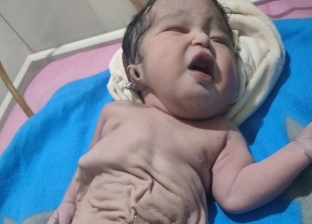 طبيب نساء وتوليد عن الطفل المولود بدون بطن: «أول مرة أشوف الحالة دي»