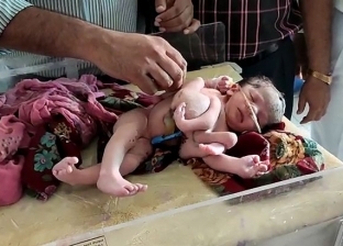 "أغرب حالة ولادة".. طفلة بـ 4 أرجل و3 أذرع في الهند