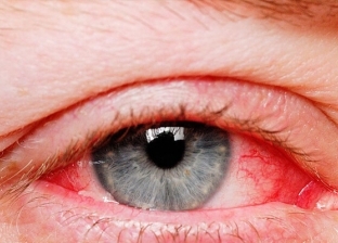 طبيب عيون: كورونا يدخل الجسم عن طريق العين وينتشر عبر الدموع