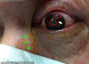 كمامة تصيب رجلاً بقطع في قرنية العين: احذروا من تلف مدى الحياة